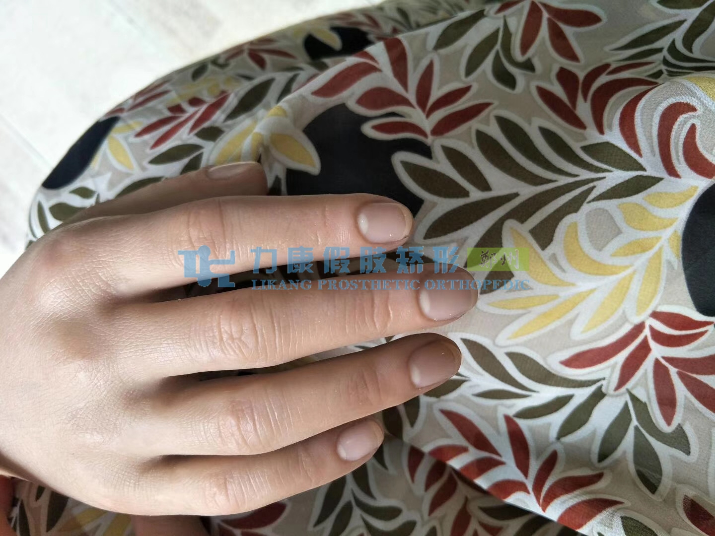 手指假肢價格多少如何進行安裝(圖1) 手指假肢價格多少如何進行安裝(圖1)